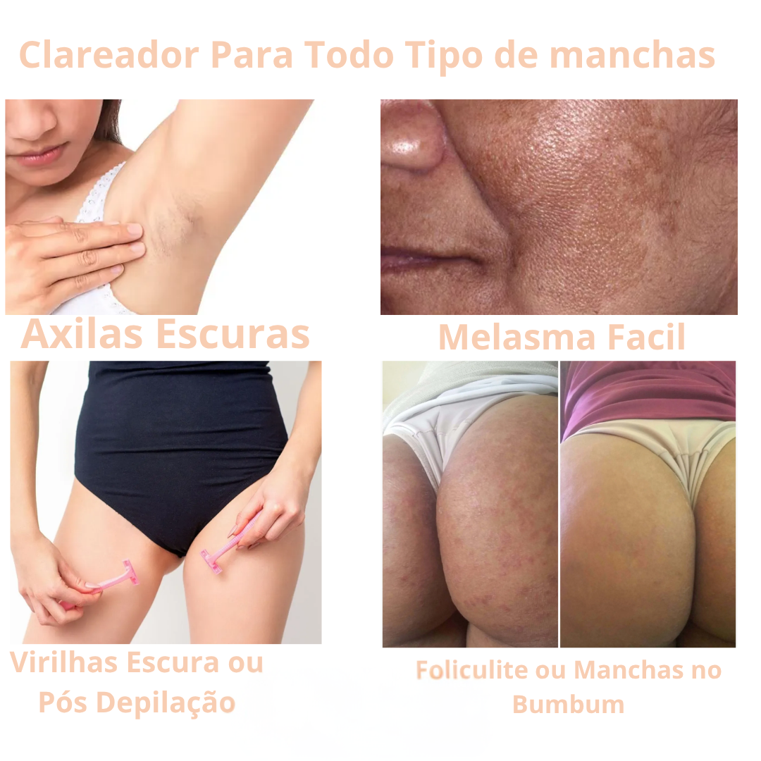 Clareador de Manchas de Pele Amazolé