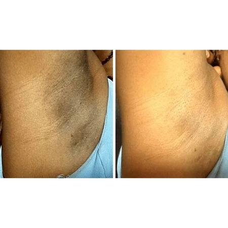 Clareador de Manchas de Pele Amazolé